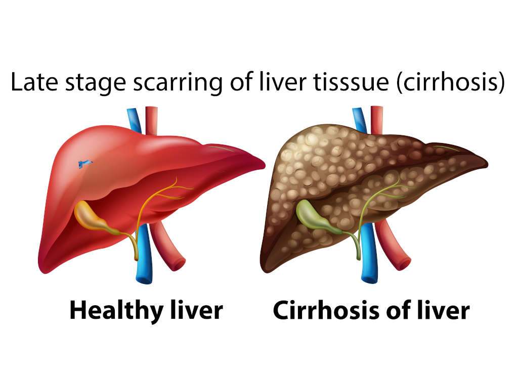 Scarred Liver and Healthy Liver | La Hacienda